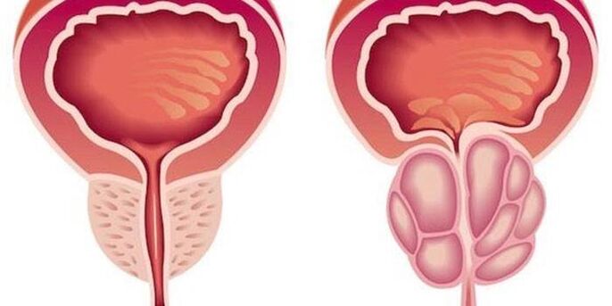 prostatitis